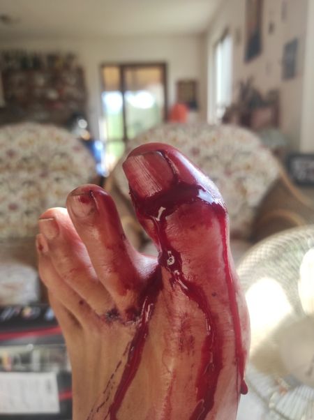 Healing Toe Wound with Herbs with DMSO Guide